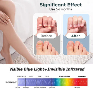 Advanced Nail Fungus Treatment & Repair Device – Home Solution for Fingernails & Toenails